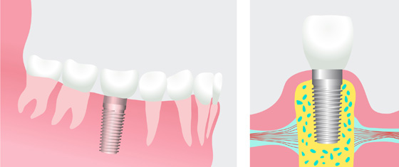 Dental Implants